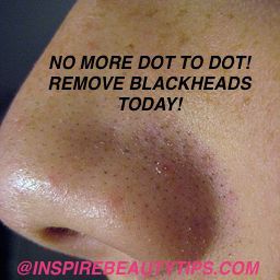 Removing Whiteheads